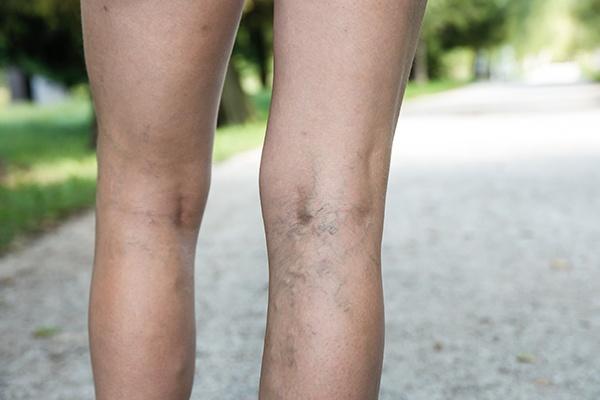 varicose veins on leg