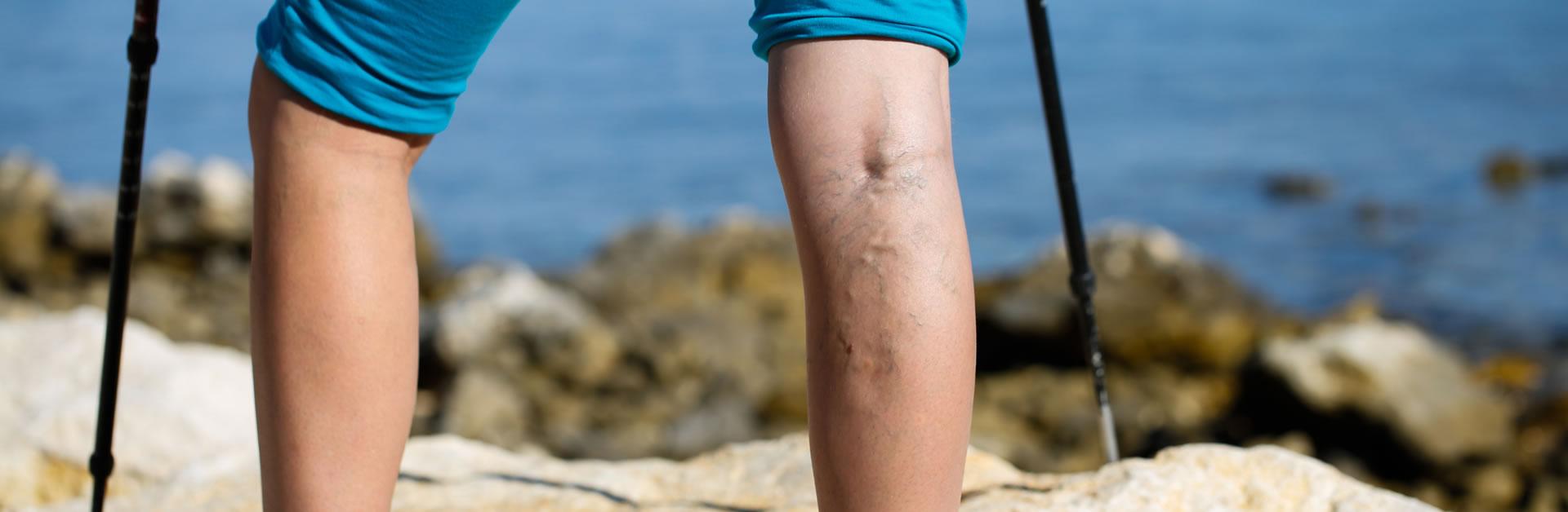 Varicose Veins